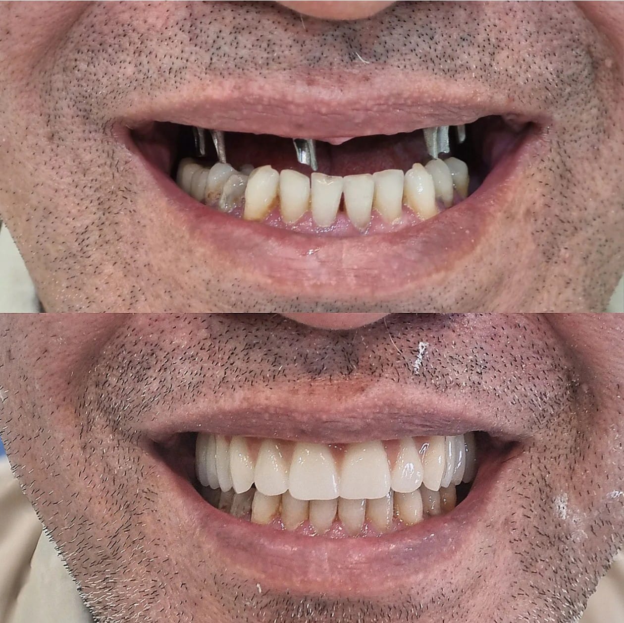 Full Mouth Rehabilitation in Shastri Nagar Delhi